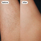 Moriqo IPL Hair Removal