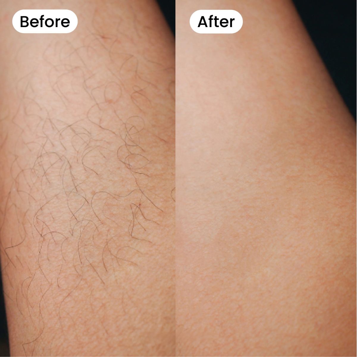 Moriqo IPL Hair Removal